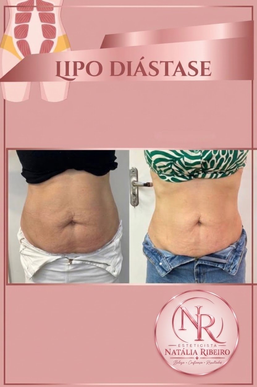 Antes e depois de 6 sessões de lipo de diástase