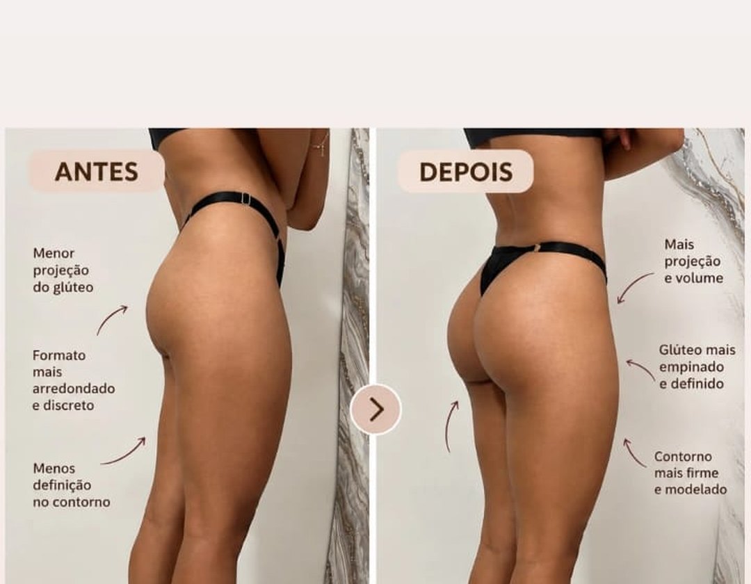 Resultado Pump Up: antes e depois do glúteo
